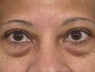 Patient # 85611 Before Photo # 1