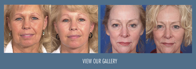 facelift