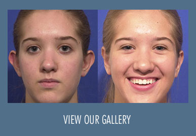 otoplasty